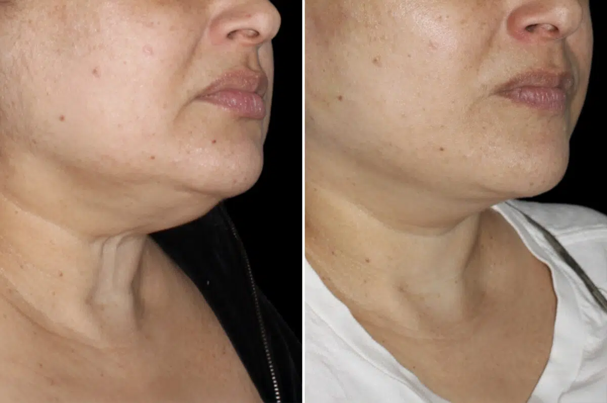 Patient 4049, Facelift & Necklift Before and After Photos Facelift & Necklift Before and After Photos in CA, Irvine, Patient 4049