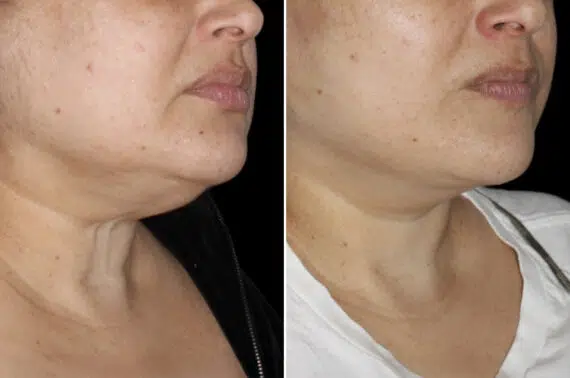 Facelift & Necklift Before and After Photos in CA, Irvine, Patient 4049
