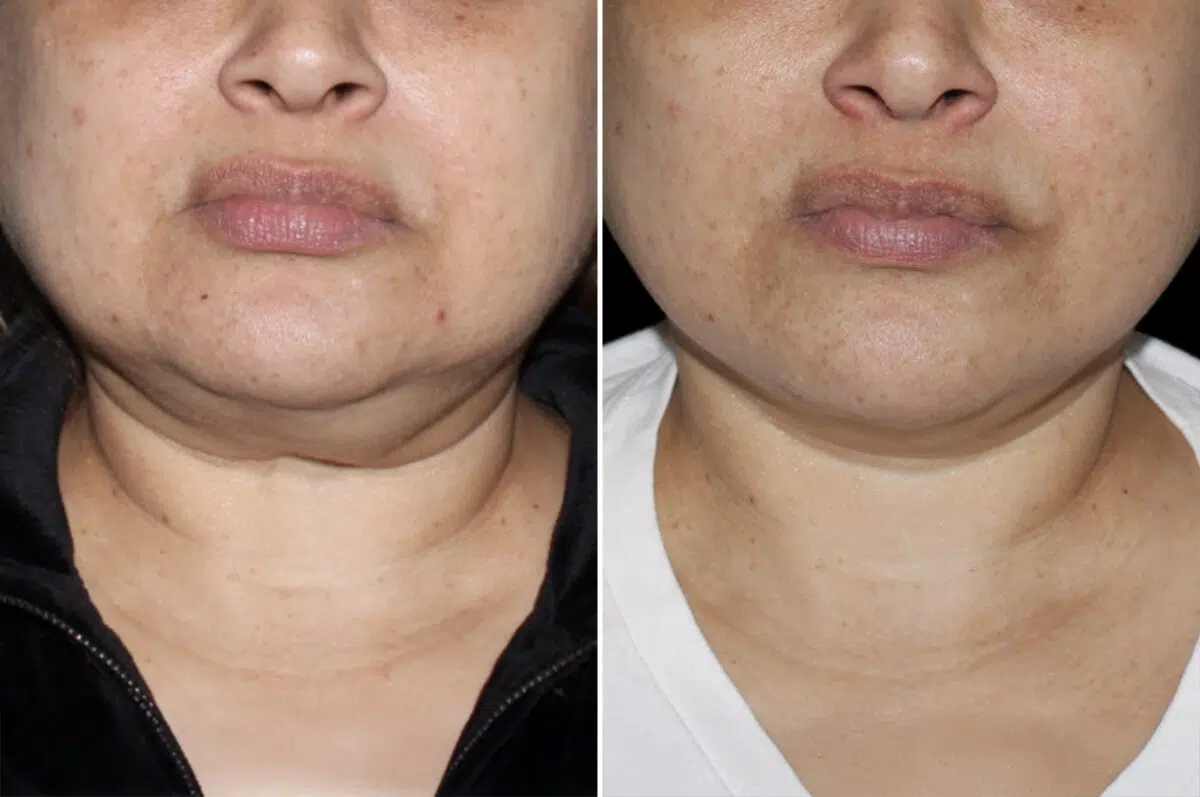 Patient 4049, Facelift & Necklift Before and After Photos Facelift & Necklift Before and After Photos in CA, Irvine, Patient 4049