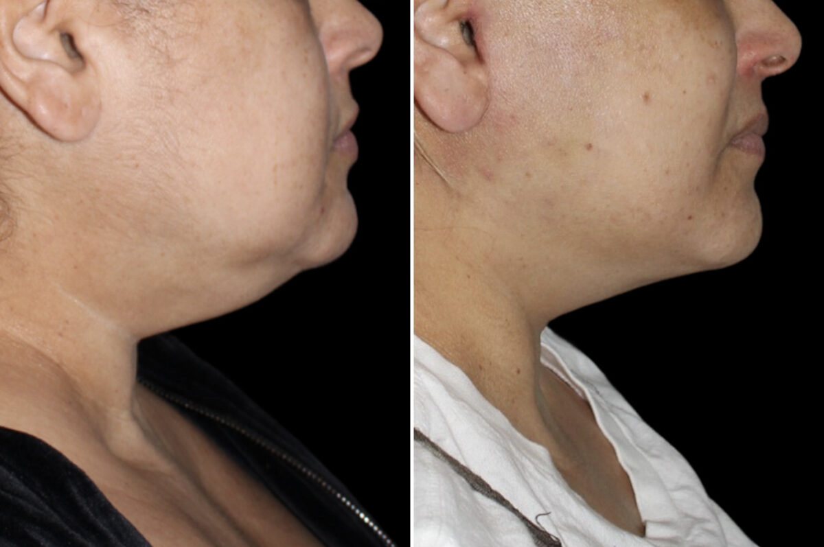 Patient 4049, Facelift & Necklift Before and After Photos Facelift & Necklift Before and After Photos in CA, Irvine, Patient 4049