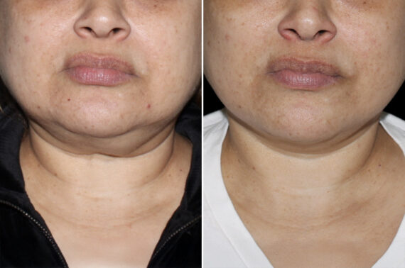 Facelift & Necklift Before and After Photos in CA, Irvine, Patient 4049