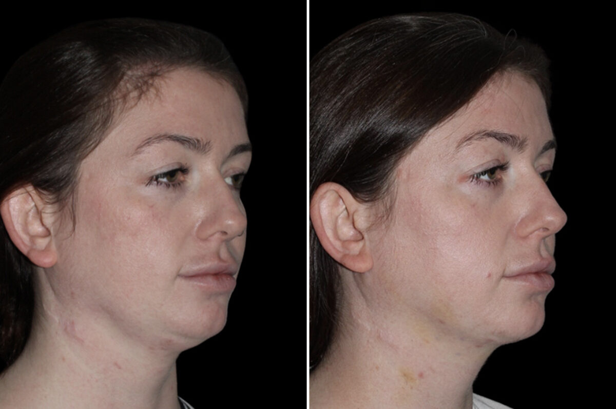 Double Chin Lipo Before and After Photos in CA, Irvine, Patient 4059