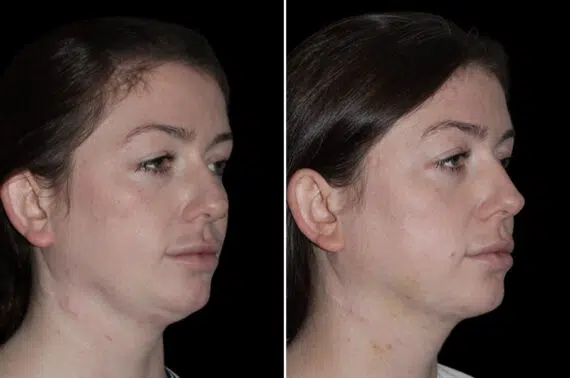 Double Chin Lipo Before and After Photos in CA, Irvine, Patient 4059