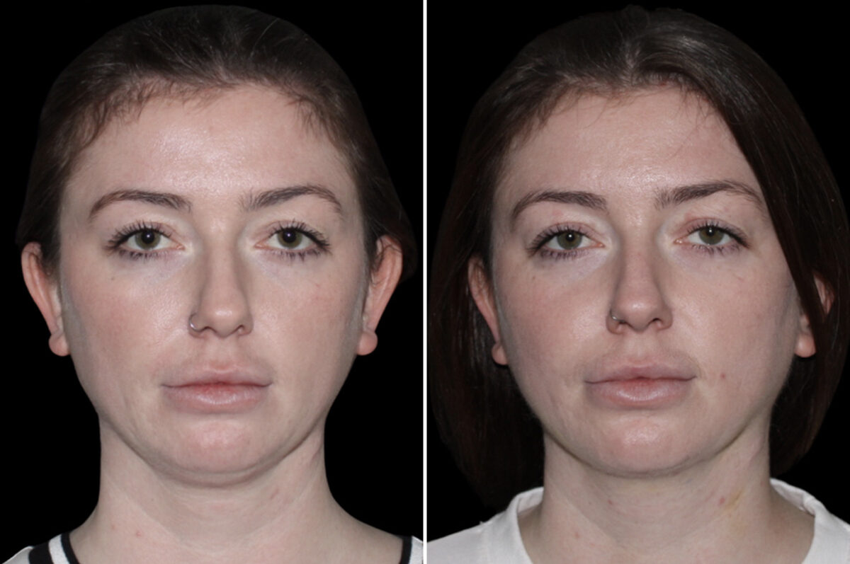 Double Chin Lipo Before and After Photos in CA, Irvine, Patient 4059
