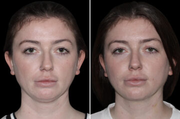 Double Chin Lipo Before and After Photos in CA, Irvine, Patient 4059
