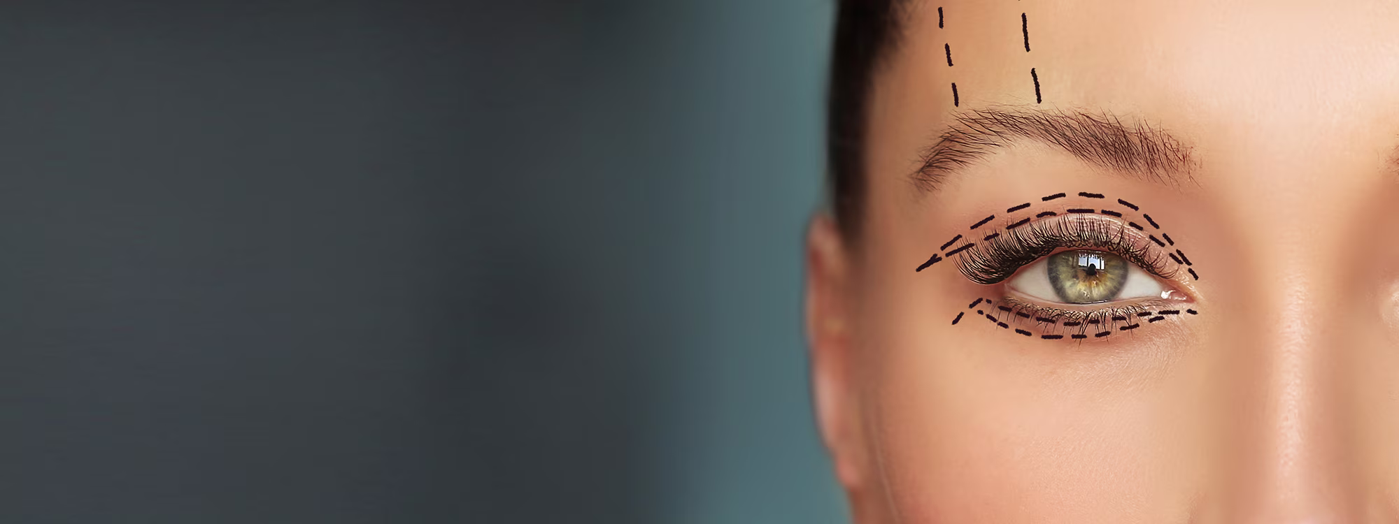 Blepharoplasty in Irvine, CA