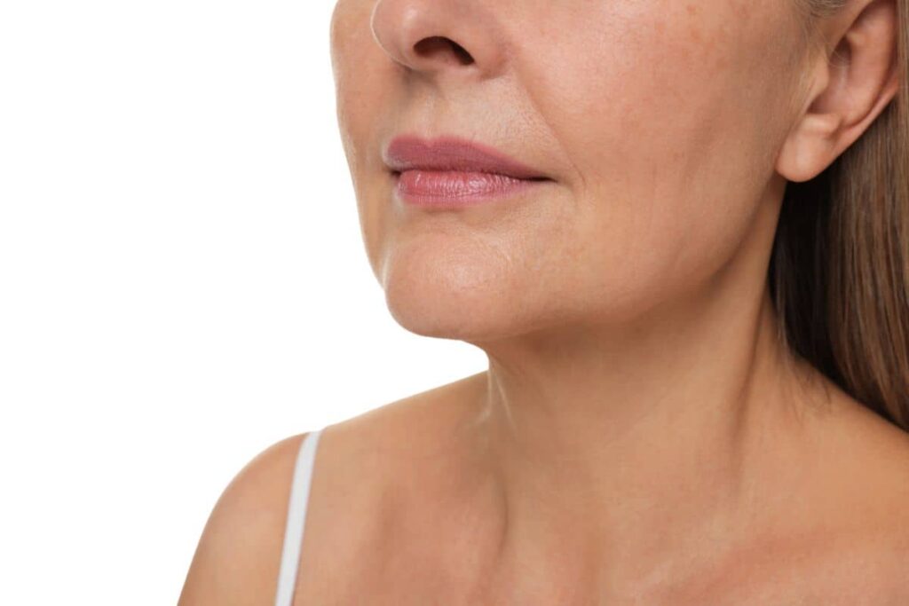 Side view of woman’s lower face and lips, highlighting skin smoothness and sustained outcome of lip lift surgery.