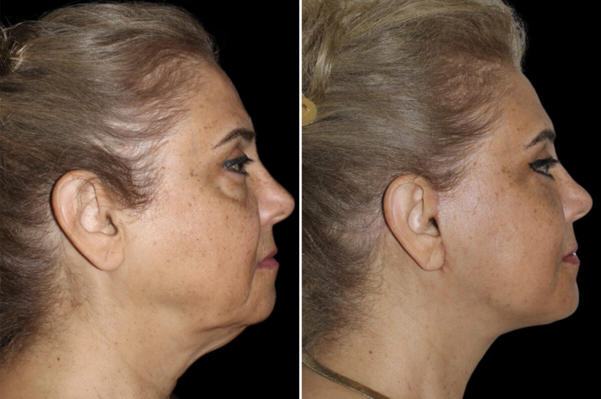 Blepharoplasty Before and After Photos in CA, Irvine, Patient 4147