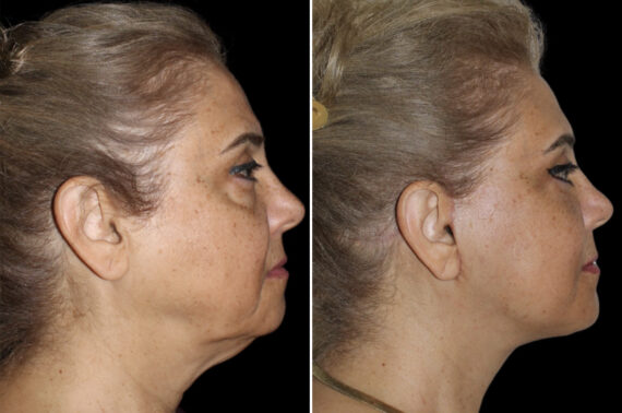 Blepharoplasty Before and After Photos in CA, Irvine, Patient 4147