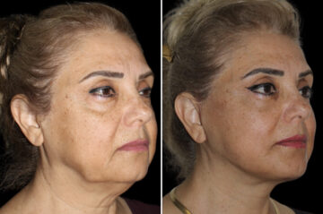 Blepharoplasty Before and After Photos in CA, Irvine, Patient 4147