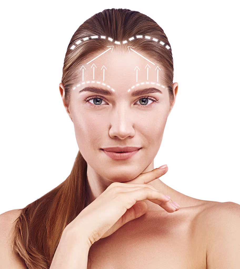 Woman with surgical brow lift markings on forehead, representing pre-surgery consultation and planning process