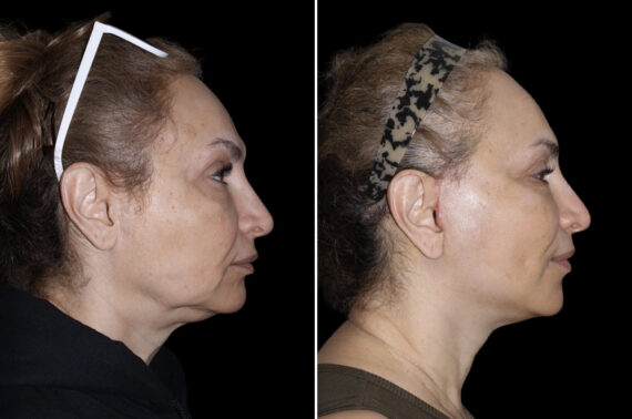 Facelift & Necklift Before and After Photos in CA, Irvine, Patient 4577
