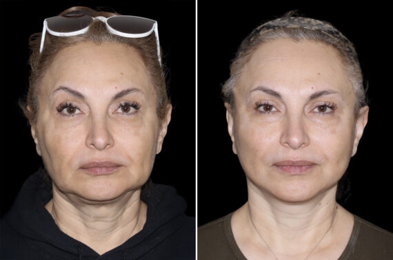 Facelift & Necklift Before and After Photos in CA, Irvine, Patient 4577