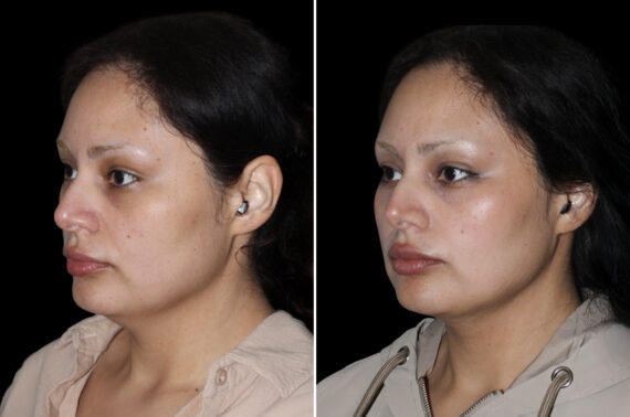 Double Chin Lipo Before and After Photos in CA, Irvine, Patient 4587