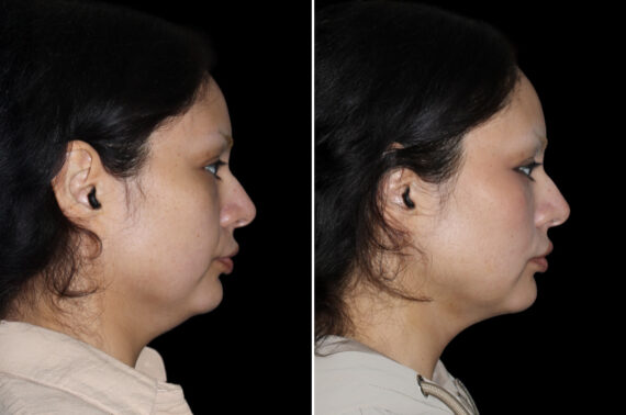 Double Chin Lipo Before and After Photos in CA, Irvine, Patient 4587