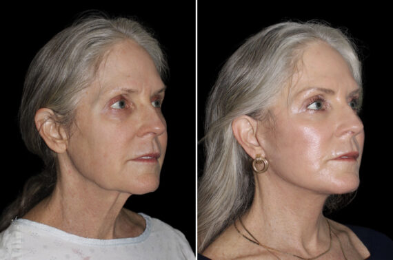 Facelift & Necklift Before and After Photos in CA, Irvine, Patient 4596