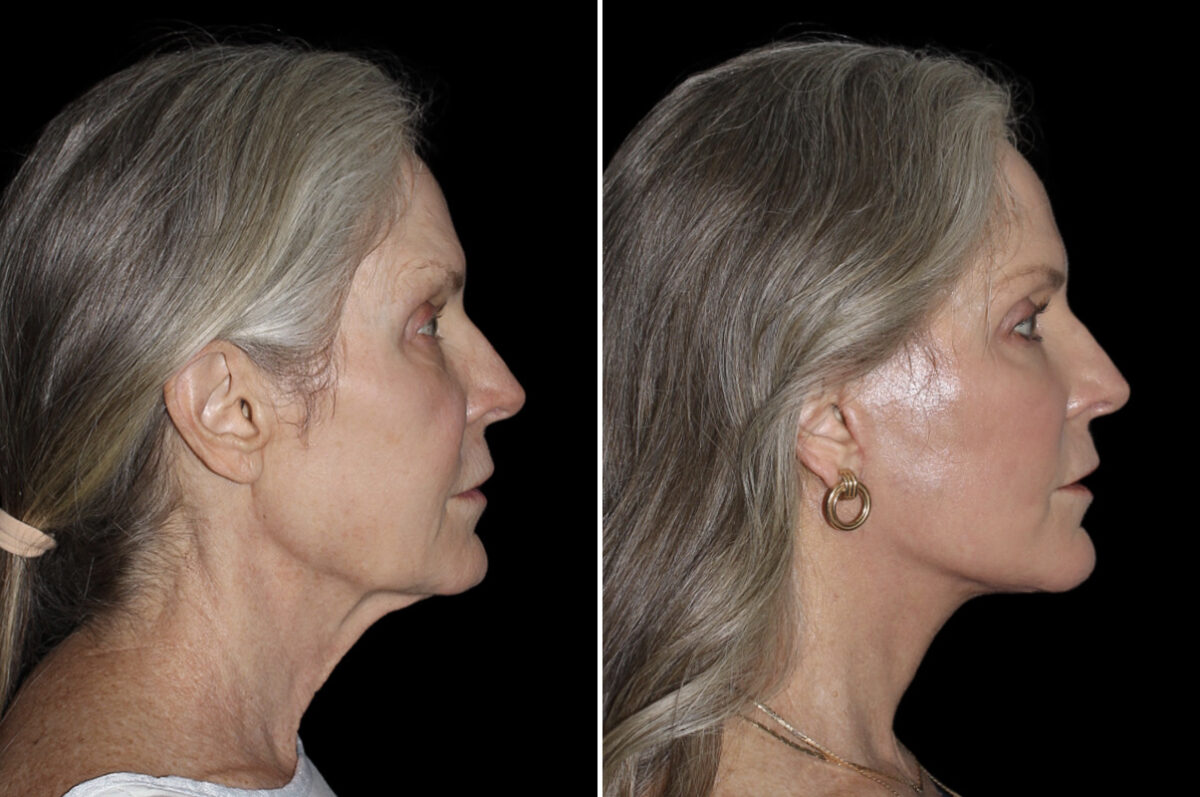 Facelift & Necklift Before and After Photos in CA, Irvine, Patient 4596
