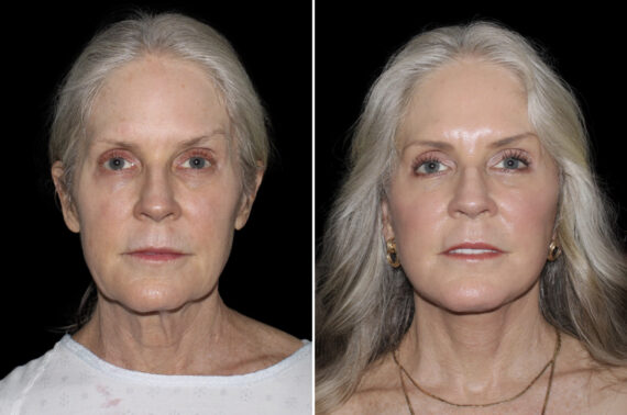 Facelift & Necklift Before and After Photos in CA, Irvine, Patient 4596