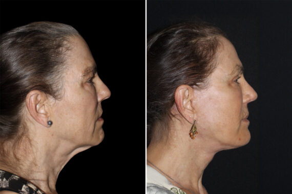 Facelift & Necklift Before and After Photos in CA, Irvine, Patient 4606