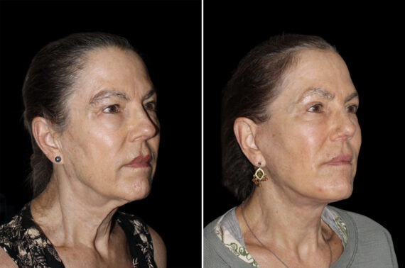 Facelift & Necklift Before and After Photos in CA, Irvine, Patient 4606