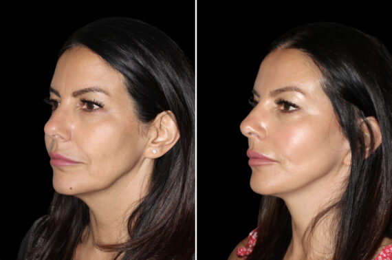 Mini Lift Before and After Photos in CA, Irvine, Patient 4613