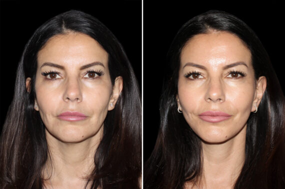 Mini Lift Before and After Photos in CA, Irvine, Patient 4613