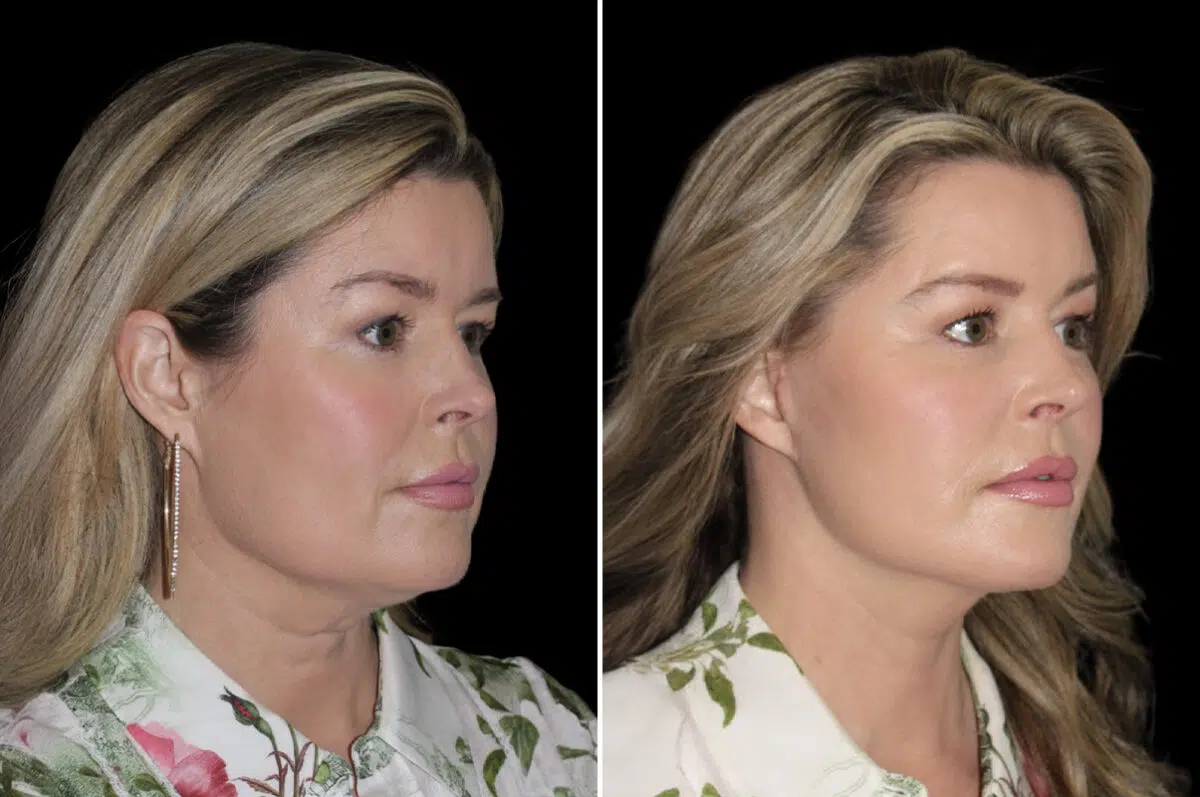 Facelift & Necklift Before and After Photos in CA, Irvine, Patient 4623