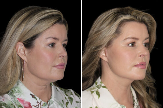 Facelift & Necklift Before and After Photos in CA, Irvine, Patient 4623