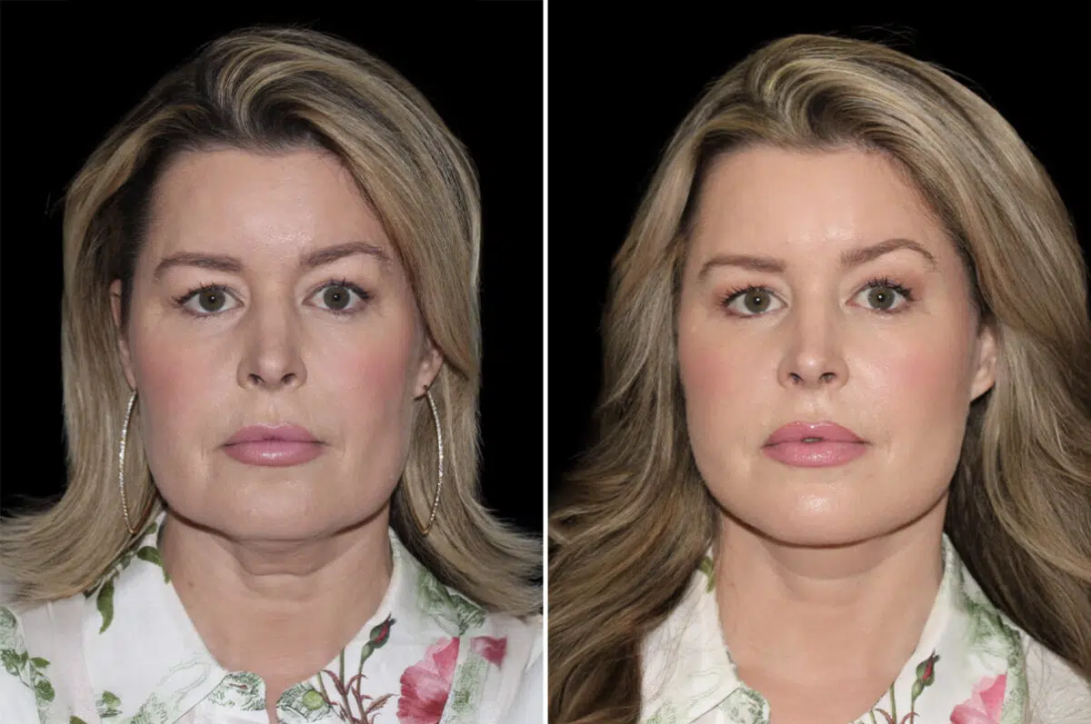Facelift & Necklift Before and After Photos in CA, Irvine, Patient 4623