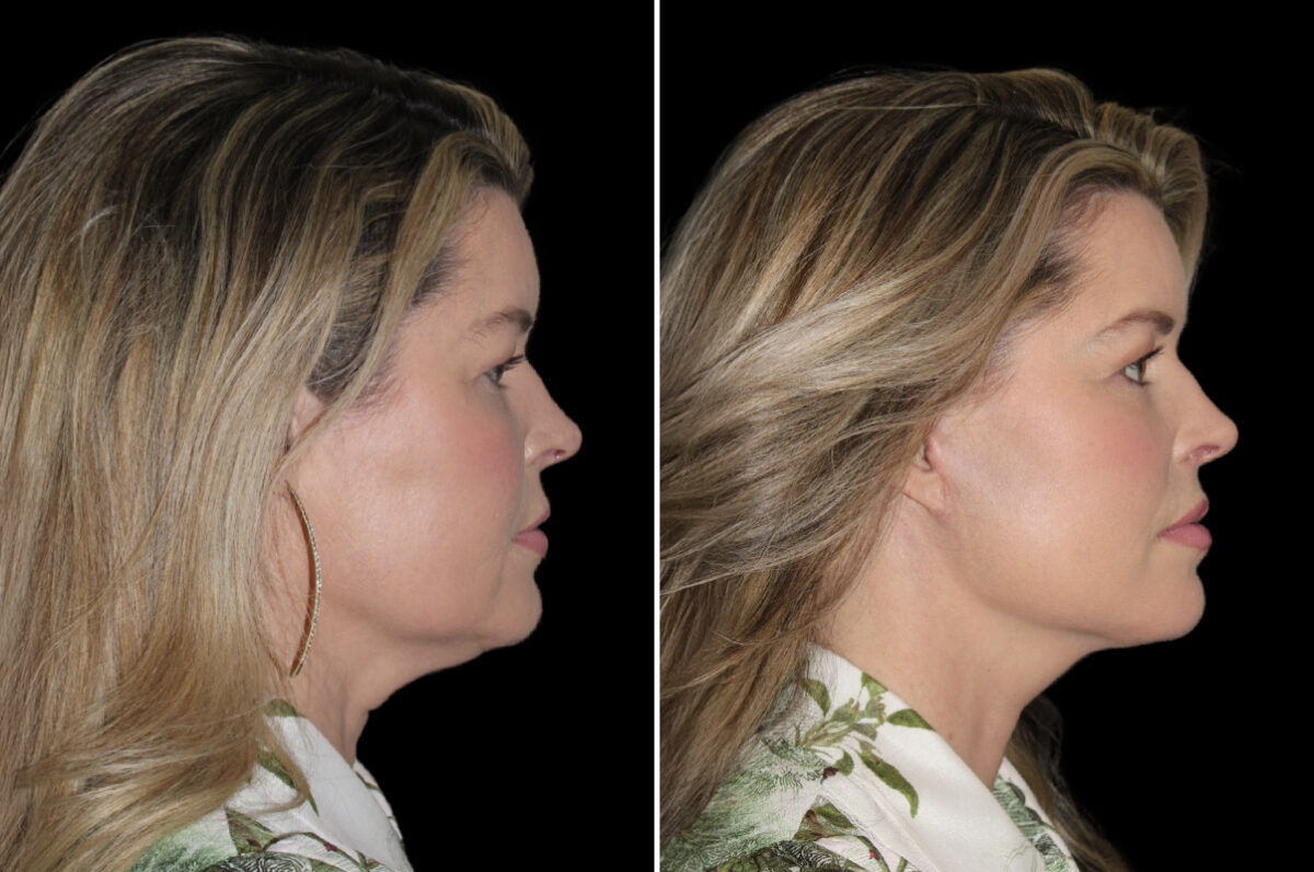 Facelift & Necklift Before and After Photos in CA, Irvine, Patient 4623