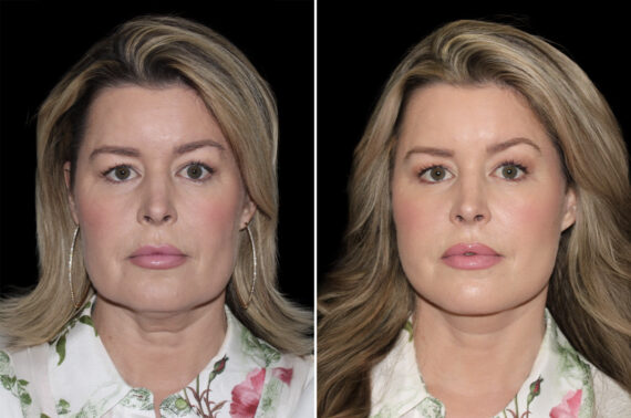 Facelift & Necklift Before and After Photos in CA, Irvine, Patient 4623