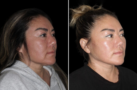 Facelift & Necklift Before and After Photos in CA, Irvine, Patient 4633