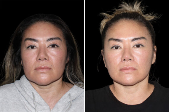 Facelift & Necklift Before and After Photos in CA, Irvine, Patient 4633