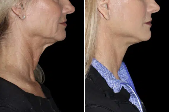 Facelift & Necklift Before and After Photos in CA, Irvine, Patient 4643