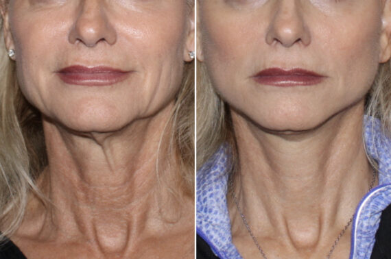 Facelift & Necklift Before and After Photos in CA, Irvine, Patient 4643