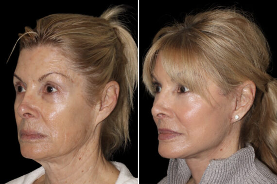 Facelift & Necklift Before and After Photos in CA, Irvine, Patient 4834