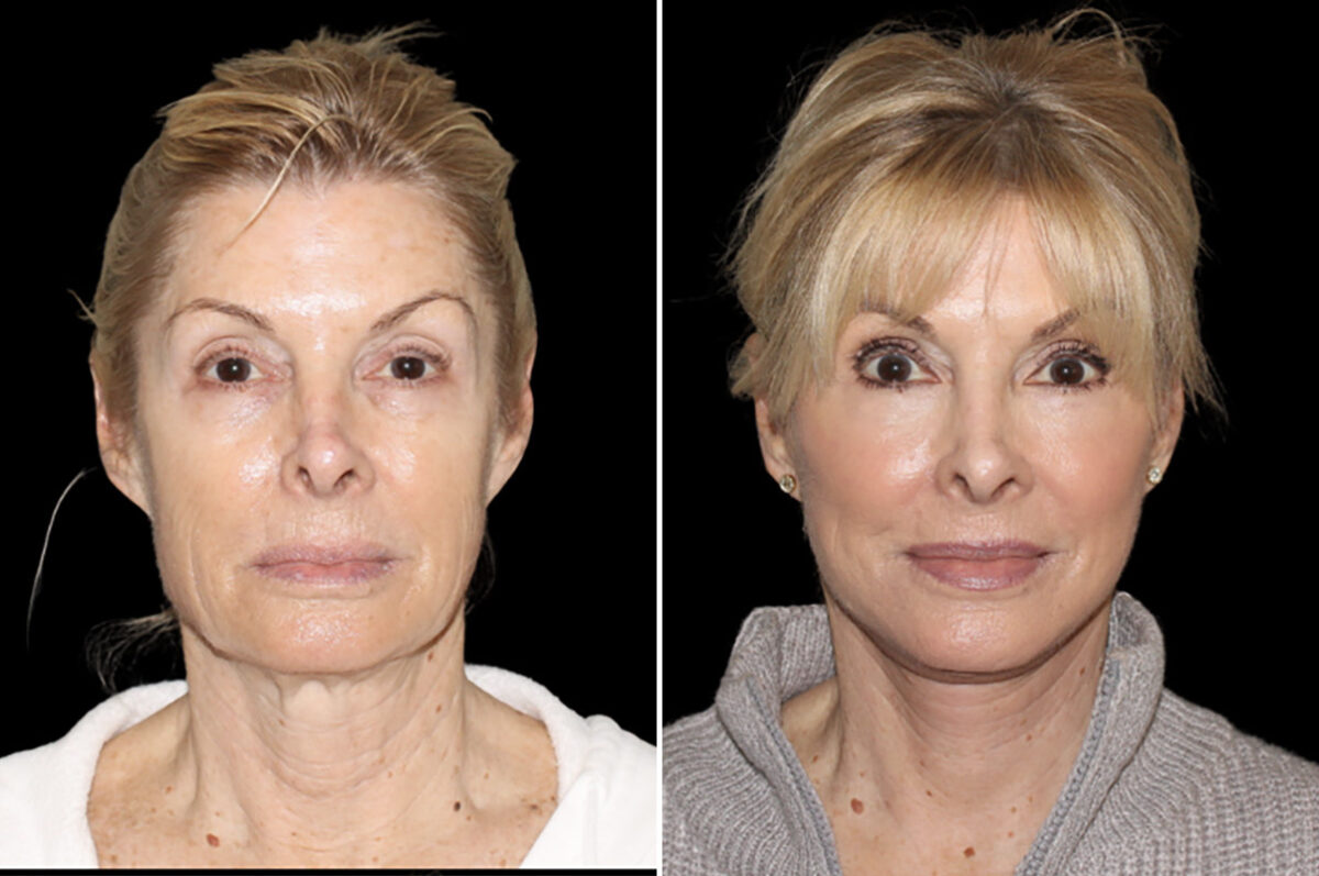 Facelift & Necklift Before and After Photos in CA, Irvine, Patient 4834
