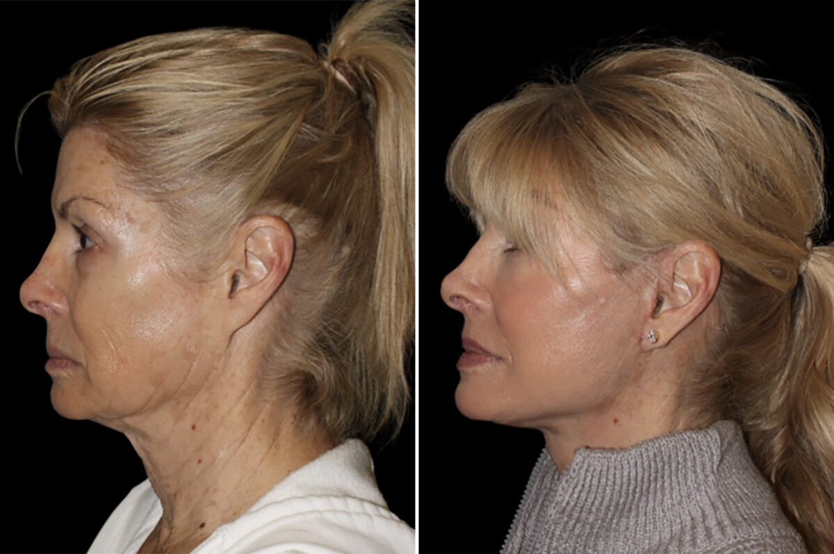 Facelift & Necklift Before and After Photos in CA, Irvine, Patient 4834