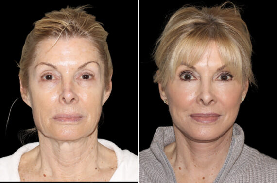 Facelift & Necklift Before and After Photos in CA, Irvine, Patient 4834