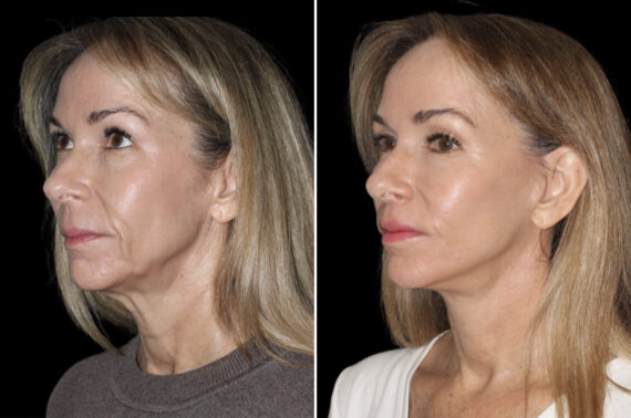 Facelift & Necklift Before and After Photos in CA, Irvine, Patient 4880