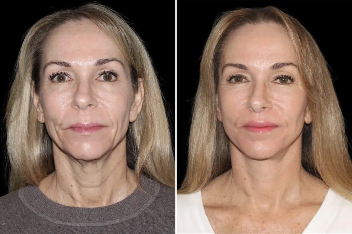 Facelift & Necklift Before and After Photos in CA, Irvine, Patient 4880