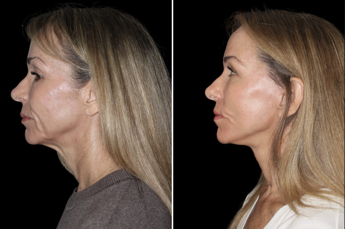 Facelift & Necklift Before and After Photos in CA, Irvine, Patient 4880