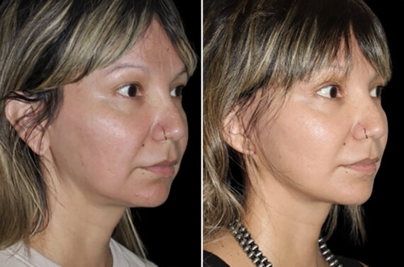 Mini Lift Before and After Photos in CA, Irvine, Patient 4884