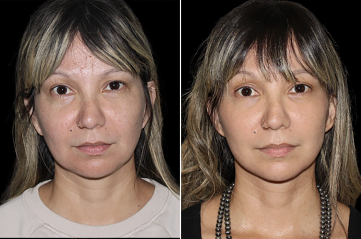 Mini Lift Before and After Photos in CA, Irvine, Patient 4884