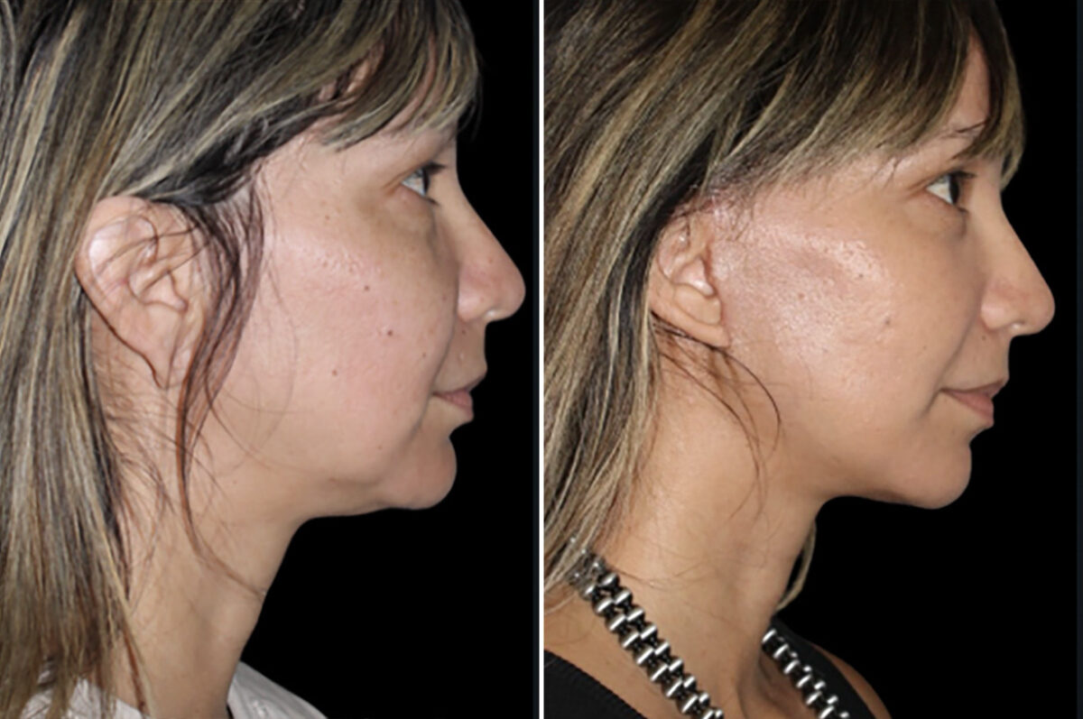 Mini Lift Before and After Photos in CA, Irvine, Patient 4884