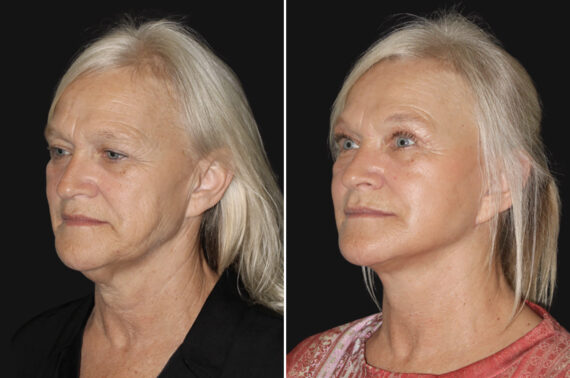 Facelift & Necklift Before and After Photos in CA, Irvine, Patient 4889