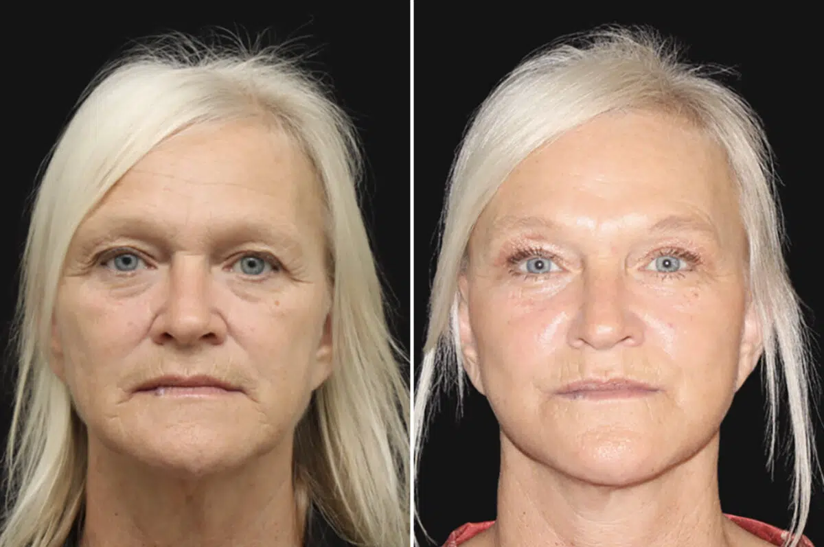 Facelift & Necklift Before and After Photos in CA, Irvine, Patient 4889