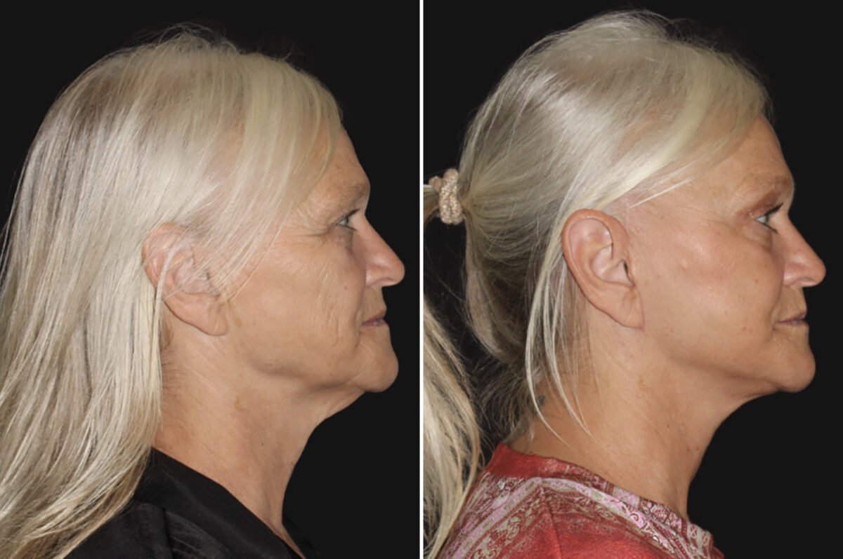 Facelift & Necklift Before and After Photos in CA, Irvine, Patient 4889