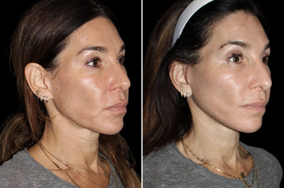 Facelift & Necklift Before and After Photos in CA, Irvine, Patient 4893