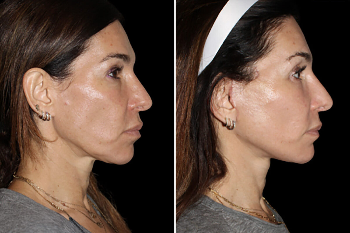 Facelift & Necklift Before and After Photos in CA, Irvine, Patient 4893